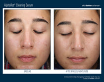SkinBetter Science AlphaRet Clearing Serum (1.7 oz)
