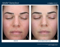 SkinBetter Science AlphaRet Clearing Serum (1.7 oz)