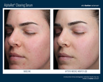 SkinBetter Science AlphaRet Clearing Serum (1.7 oz)