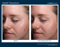 SkinBetter Science AlphaRet Clearing Serum (1.7 oz)